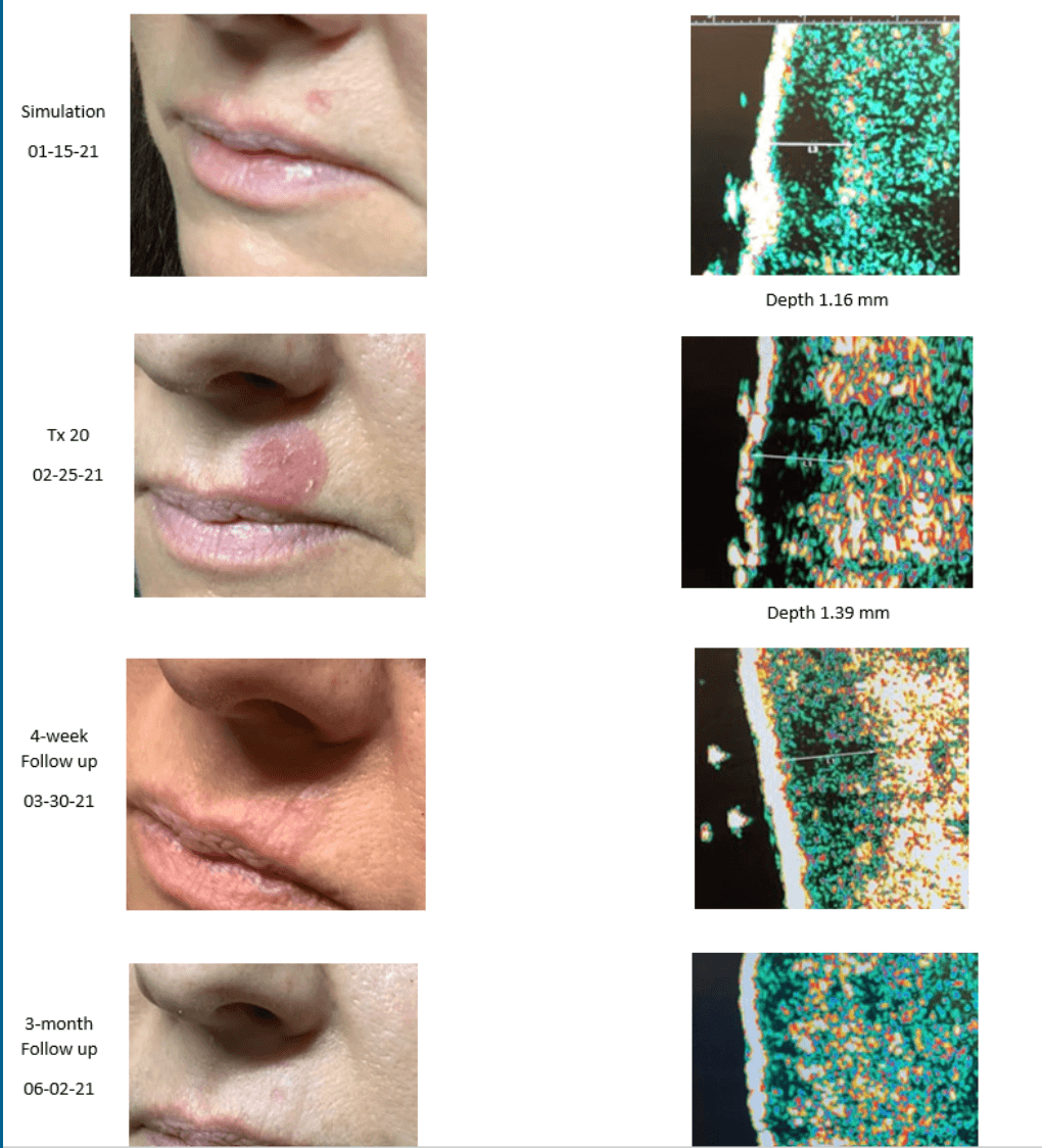 pinnacleskin.com /treatments/superficial-radiation-therapy Carousel 1 Image 1