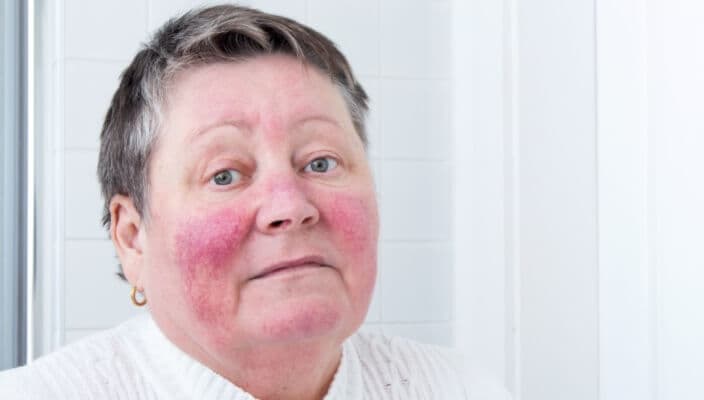 My Experience with Rosacea