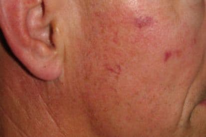 example-of-a-birthmark