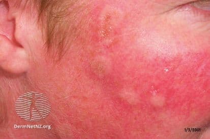 pinnacleskin.com /treatments/cryosurgery Carousel 1 Image 2