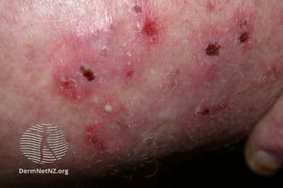 ringworm-example