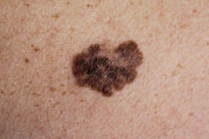 pinnacleskin.com /treatments/skin-cancer-screenings-and-total-body-skin-exams Carousel 1 Image 4