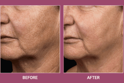 fraxel-laser-before-and-after