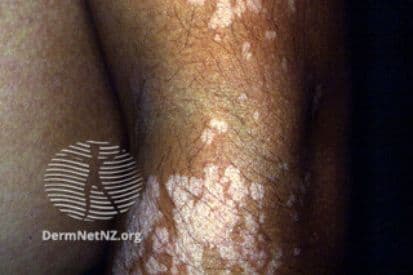 Tinea-Versicolor-example