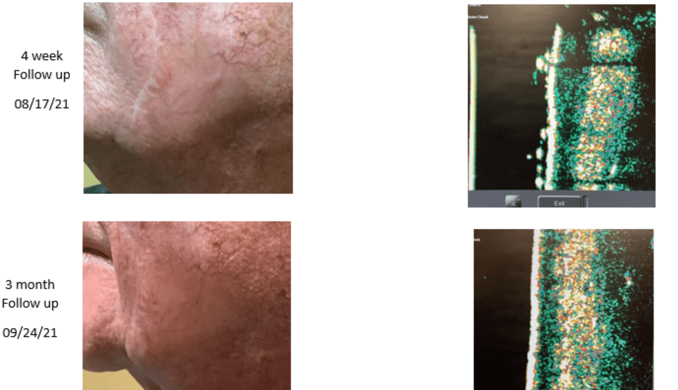 pinnacleskin.com /treatments/superficial-radiation-therapy Carousel 1 Image 3