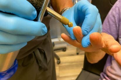 Cryosurgery-Example