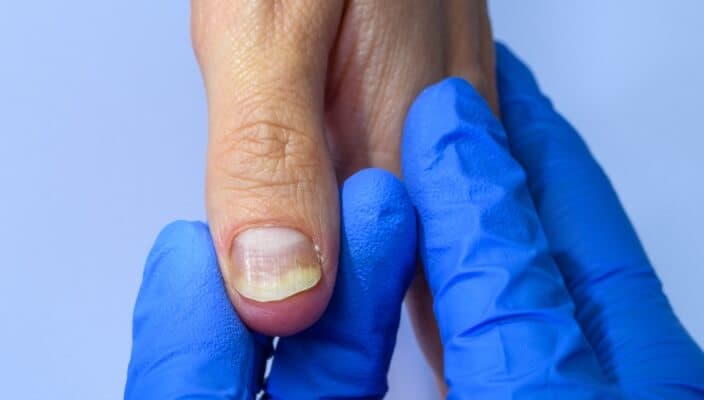 Dermatology Affiliates Clears Up Nail Fungus: Myths vs. Facts