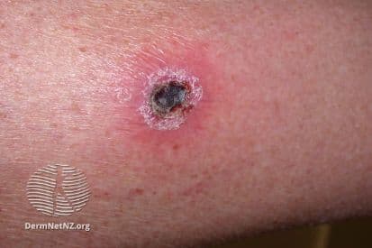pinnacleskin.com /treatments/cryosurgery Carousel 1 Image 6