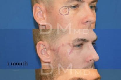 skin-cancer-removal-before-and-after-temple