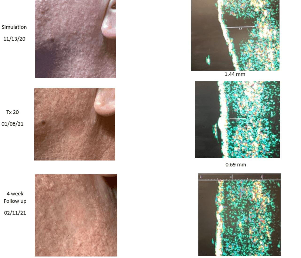 pinnacleskin.com /treatments/superficial-radiation-therapy Carousel 1 Image 2