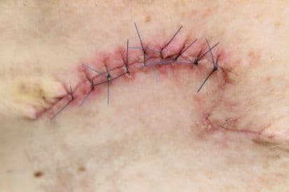 pinnacleskin.com /treatments/standard-excision Carousel 1 Image 3