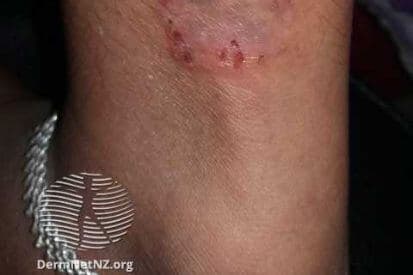 ringworm-example