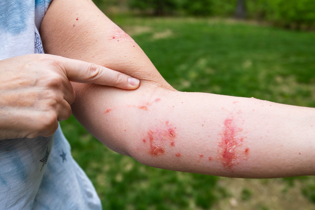 Poison ivy rash on an arm.