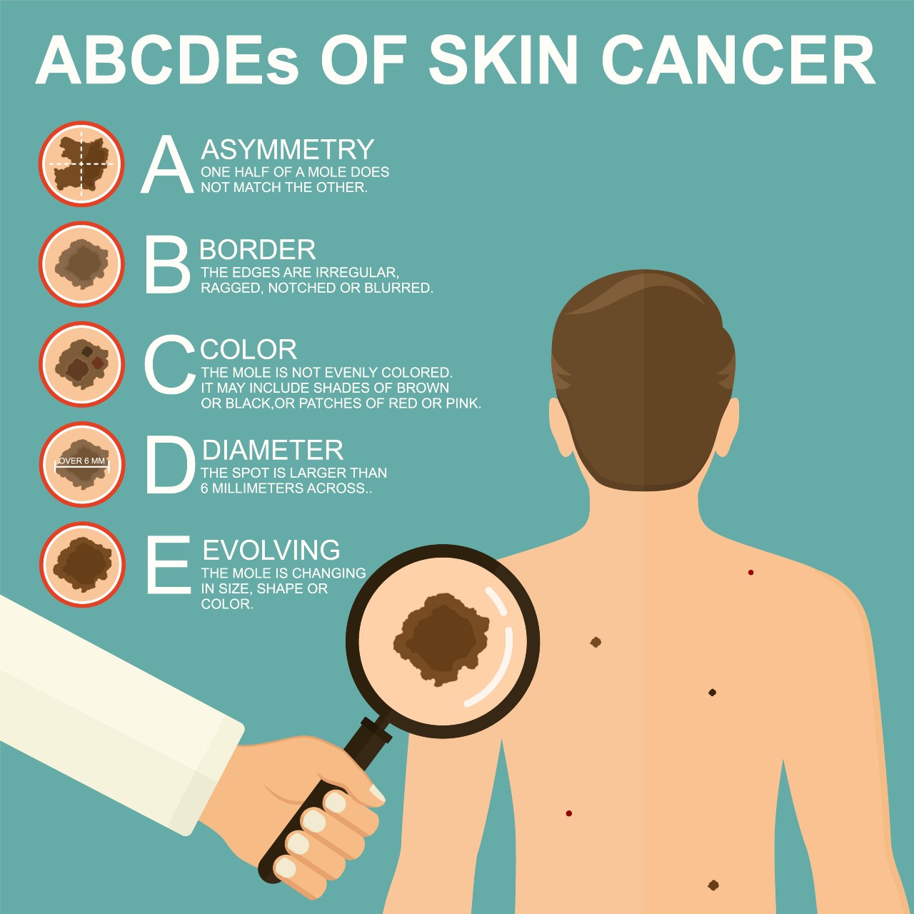 Infographic of the ABCDE's of melanoma skin cancer