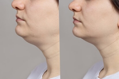 SmartLipo-1