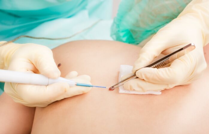 Mole removal surgery 